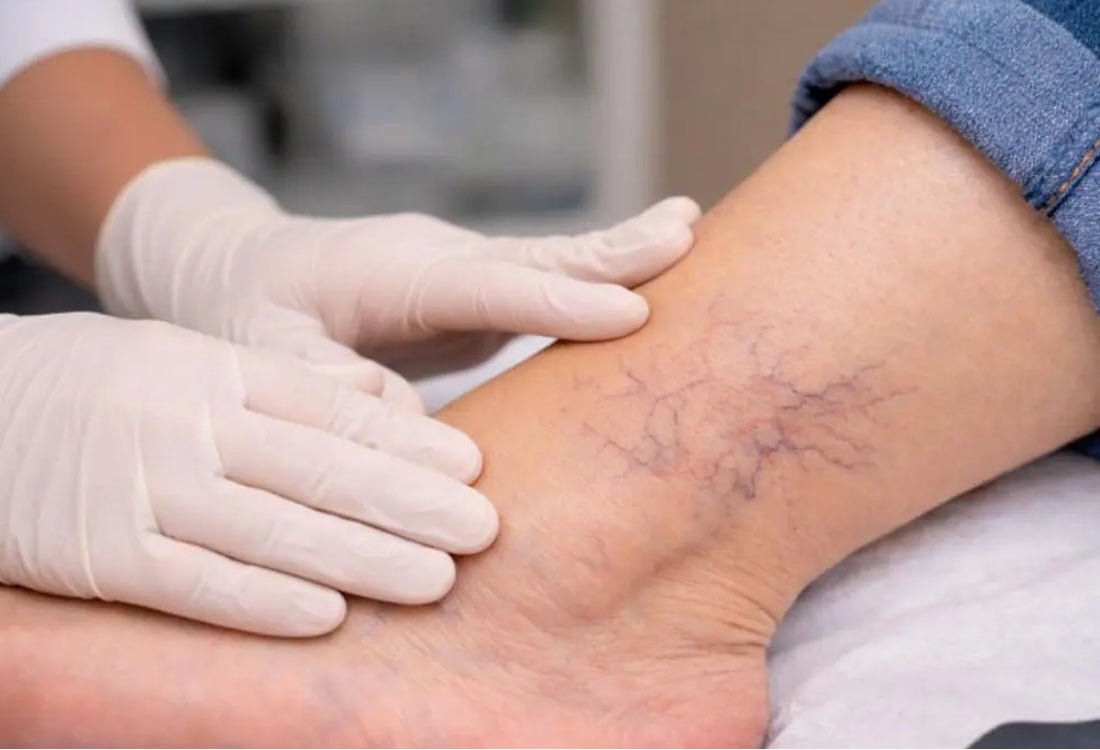 A gloved clinician examining visible spider veins on a patient's ankle during a vein health consultation