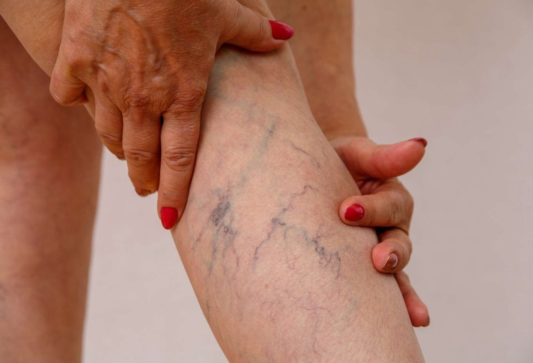 Close-up of a person's lower leg showing visible blue varicose veins, with a hand resting against the skin
