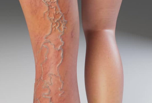 3 Best Foot Baths for Varicose Veins