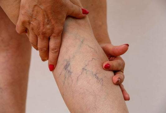 How to Reduce the Appearance of Varicose Veins: Treatment & At Home Options