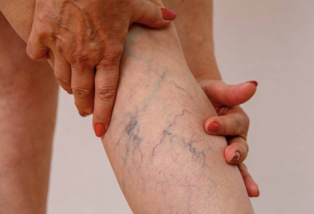 Close-up view of a person’s calf, showing the bulgy nature of varicose veins
