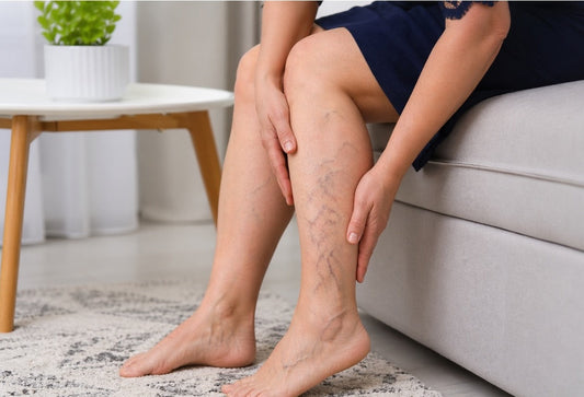 Close-up view of a person’s calf, showing varicose veins
